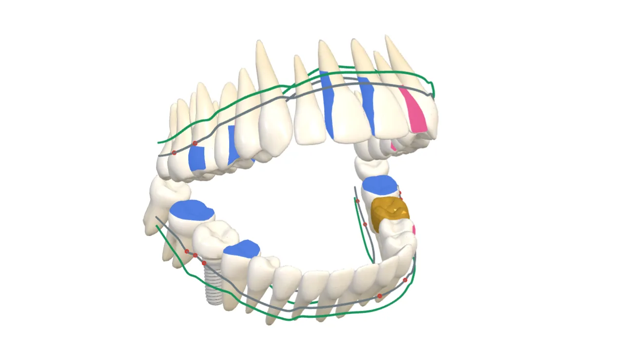 3D dental arch with a sample odontogram and periodontal chart